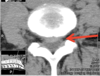 CT-Disc-Herniation.