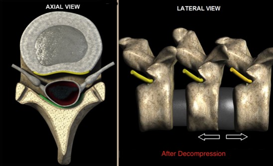 After-Spinel-Decompression