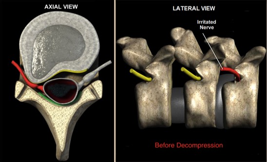 Before-Spinel-Decompression